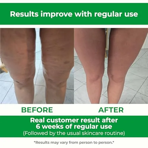 TESMED Cellulite Manual Massager Review image 4